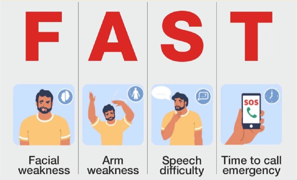 Brain Stroke: Act FAST, Save Lives